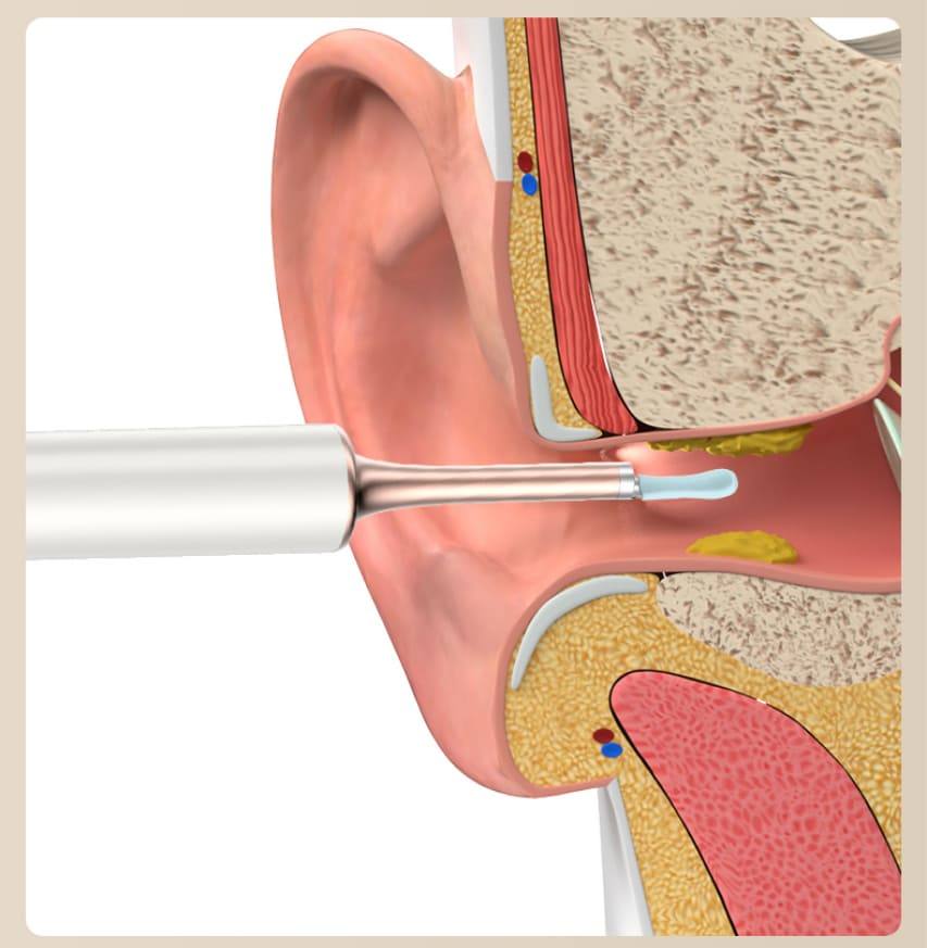 средство для удаления ушной серы чистка ушей